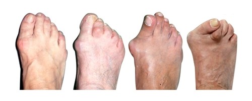 Вальгусная деформация большого пальца стопы (ноги).